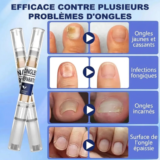Stylo antifongique. Formule avancée contre le pied d'athlète et les mycoses des ongles