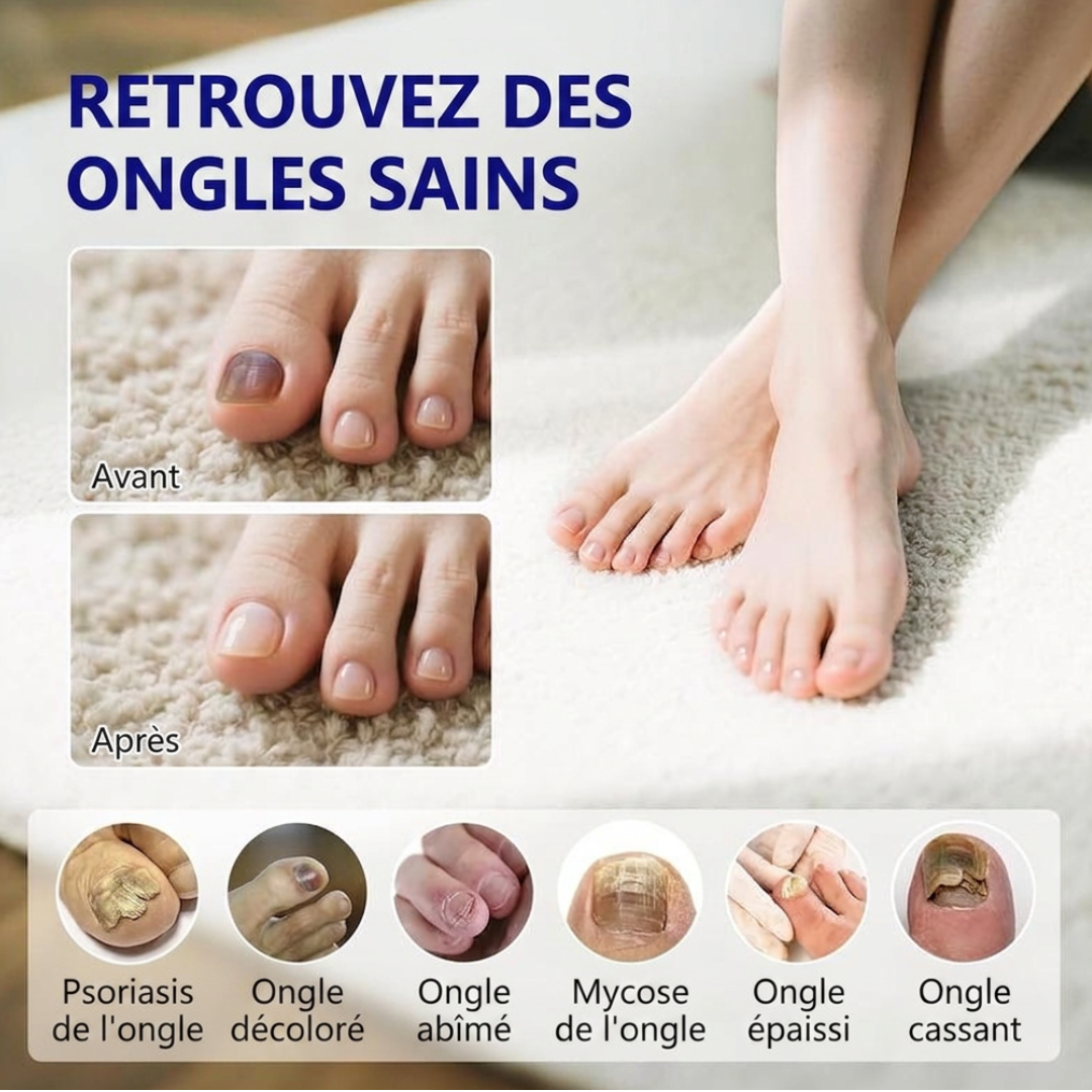 Stylo antifongique. Formule avancée contre le pied d'athlète et les mycoses des ongles